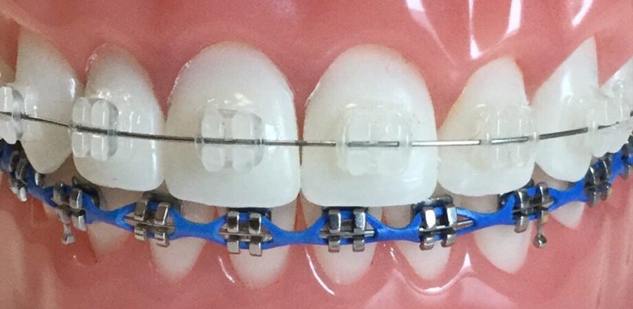 Ceramic-Braces-Vs-Metal-Braces