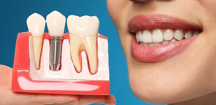 Caring for Your Dental Implants