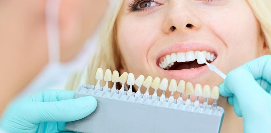 How Dental Veneers Can Correct Irregularities