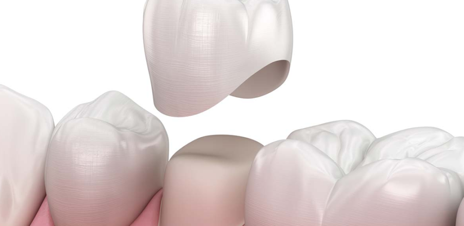 The Basics of Dental Crowns
