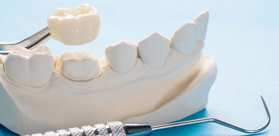 Understanding Dental Bridge Teeth in Restorative Dentistry