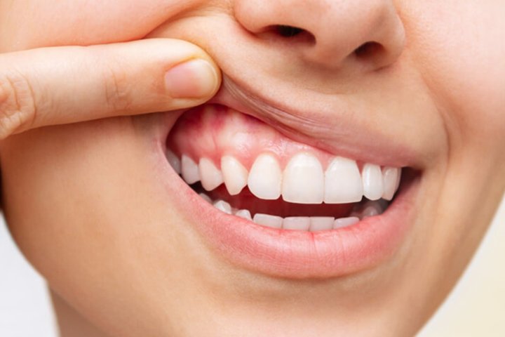 Gum Depigmentation Treatment in Dubai