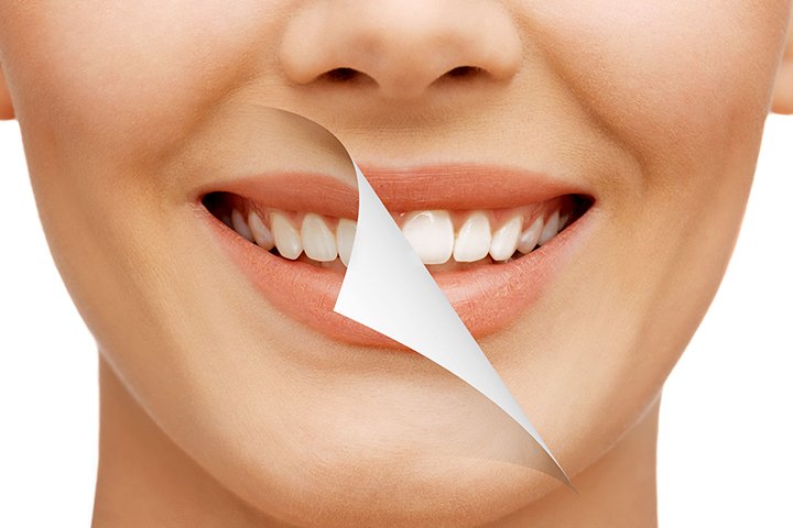 Smile Makeover in Dubai