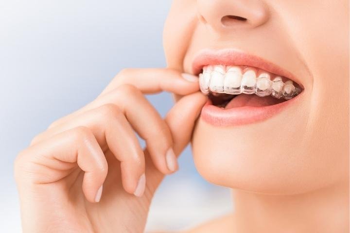 invisalign in Dubai