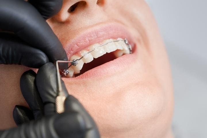 Metal & Ceramic Braces